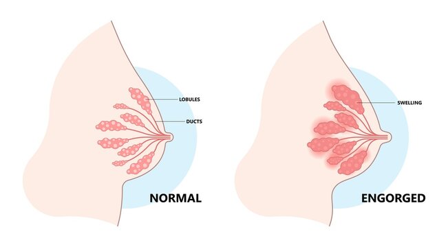 Breast Engorgement